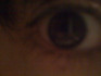 dryeye.jpg